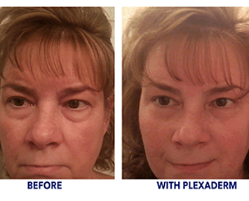 Cindy is glad she tried Plexaderm
