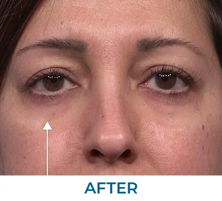 Tiffany after applying Rapid Reduction Serum
