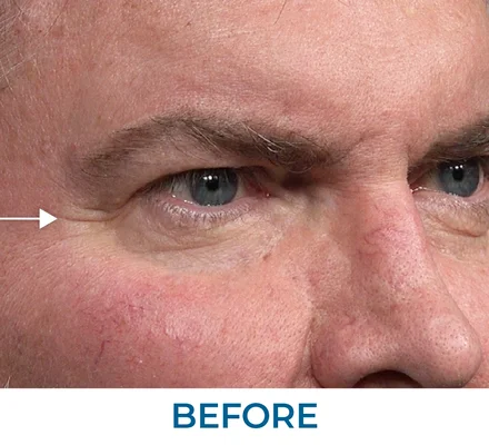 Stephen before applying Rapid Reduction Serum