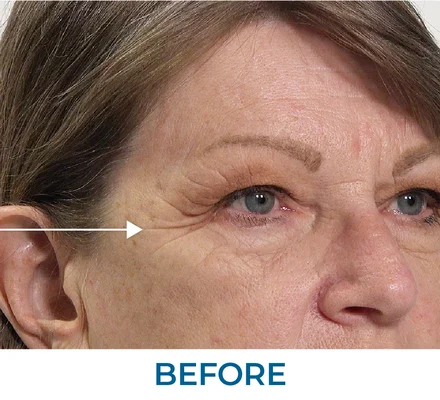 Mona Before applying Rapid Reduction Serum