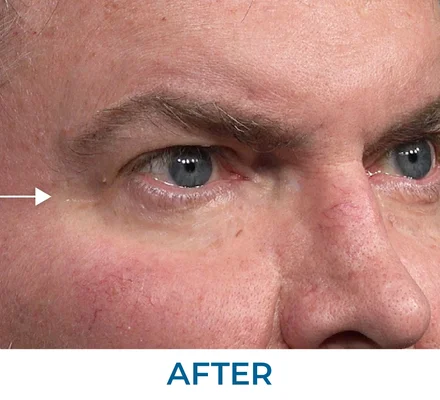 Stephen after applying Rapid Reduction Serum