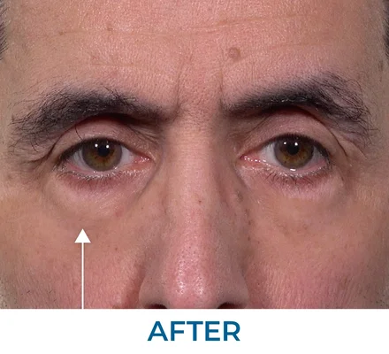 Ritchie after applying Rapid Reduction Serum