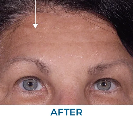 Tammy after applying Rapid Reduction Serum