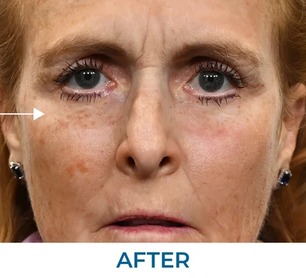 Marty after applying Rapid Reduction Serum