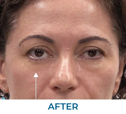 Rita after applying Rapid Reduction Serum
