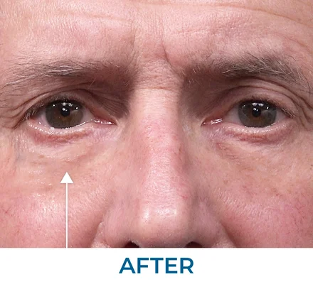 Ron after applying Rapid Reduction Serum