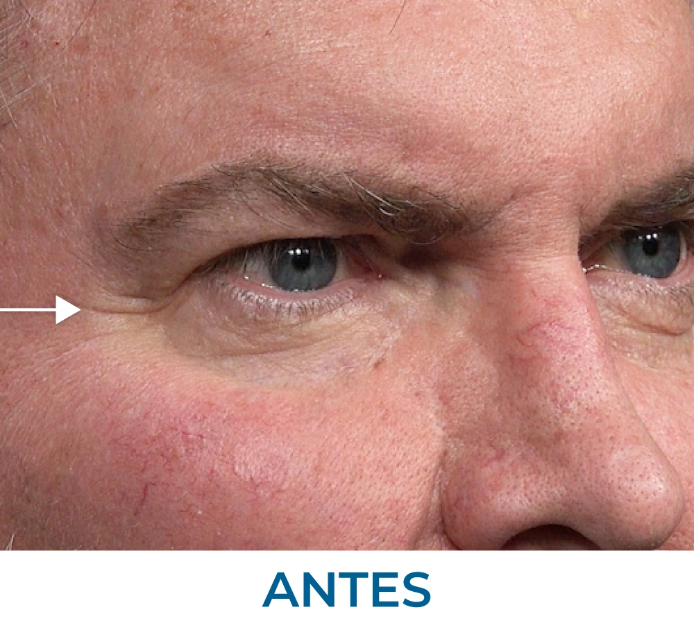 Stephen before applying Rapid Reduction Serum