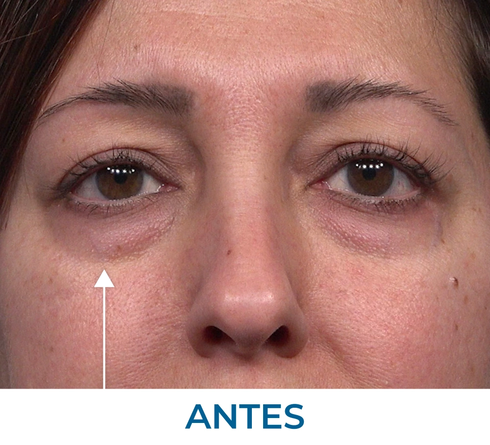 Samantha Before applying Rapid Reduction Serum