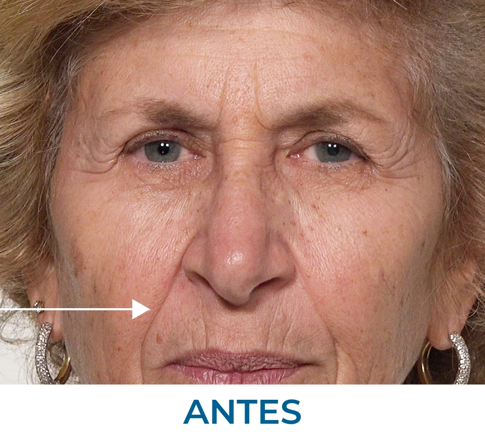 Laura Before applying Rapid Reduction Serum