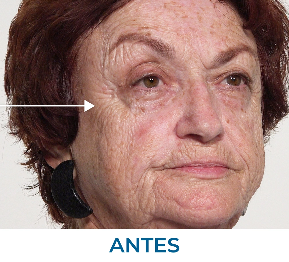 Maria Before applying Rapid Reduction Serum