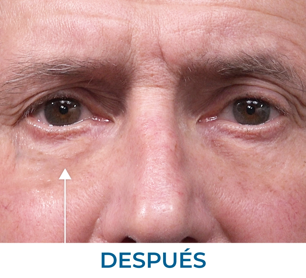 Ron after applying Rapid Reduction Serum