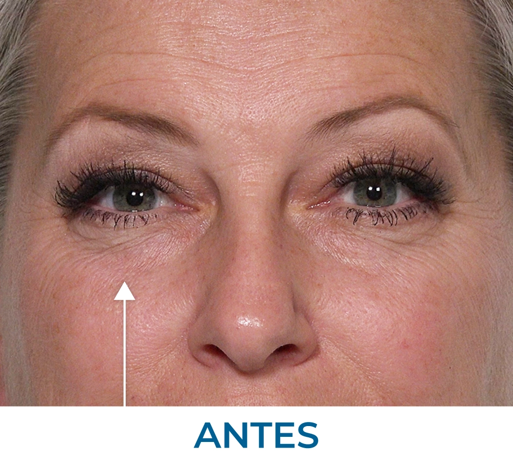 Tiffany before applying Rapid Reduction Serum