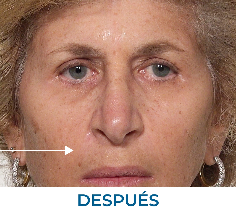 Laura after applying Rapid Reduction Serum