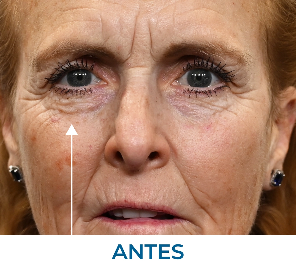 Marty before applying Rapid Reduction Serum