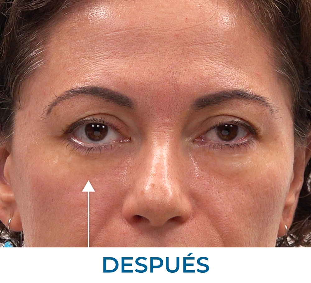 Rita after applying Rapid Reduction Serum