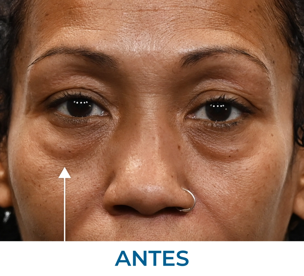 Sunny before applying Rapid Reduction Serum