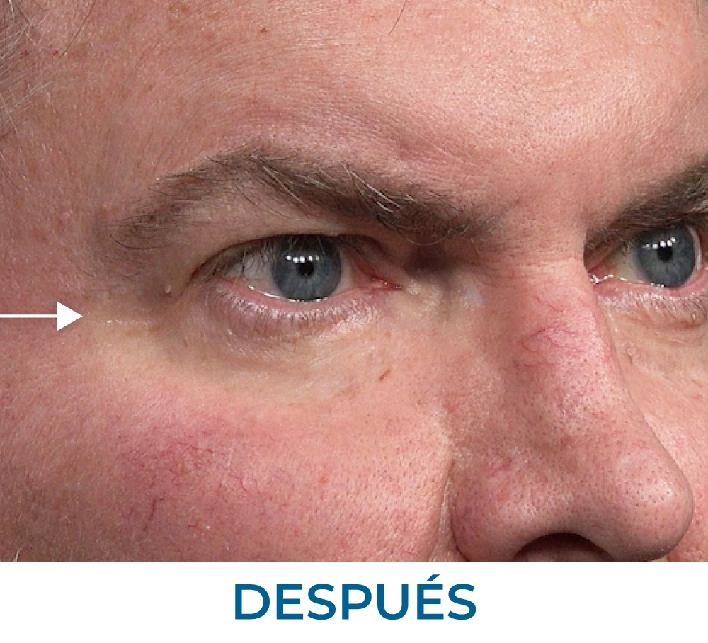 Stephen after applying Rapid Reduction Serum