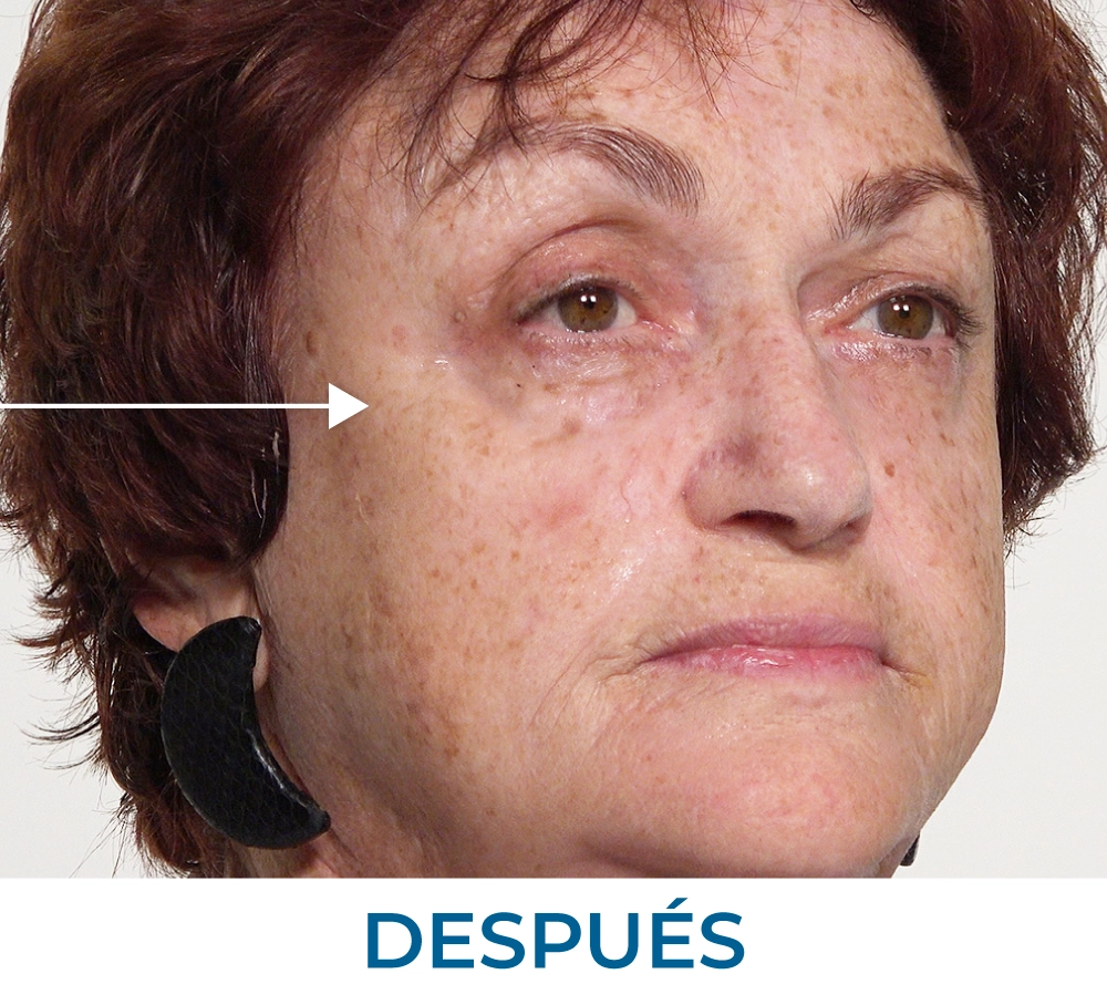 Maria after applying Rapid Reduction Serum