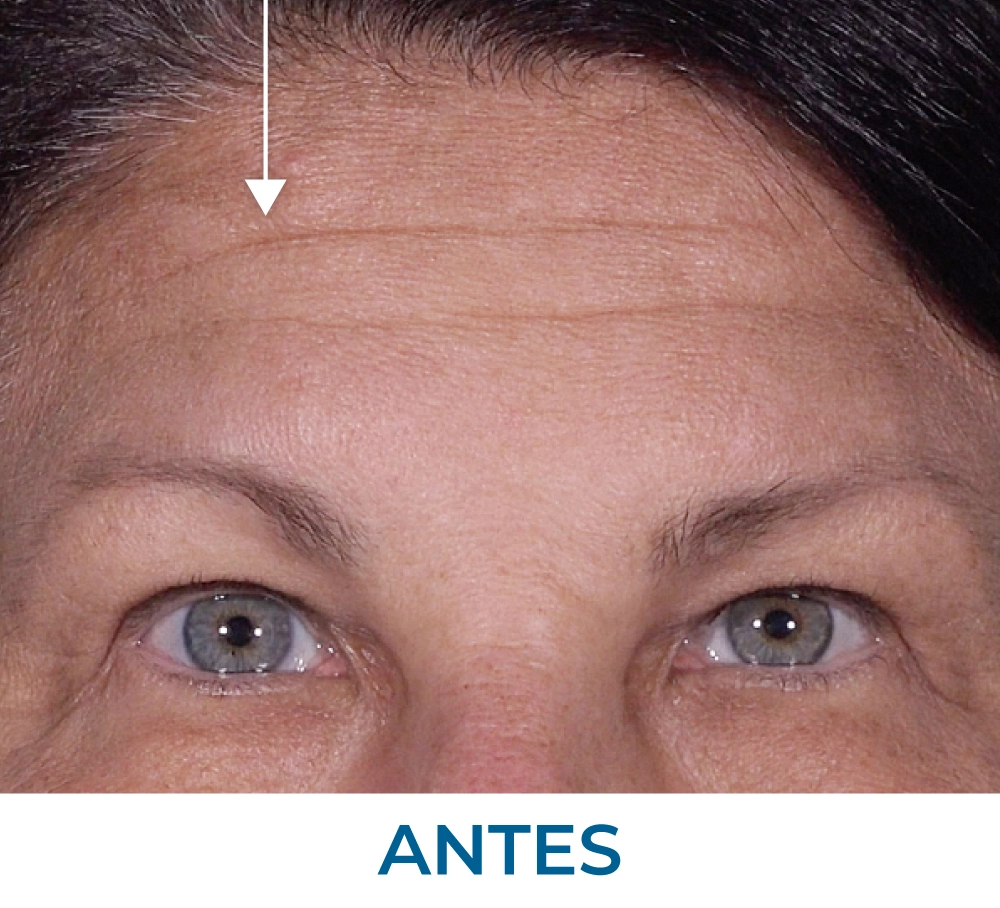 Tammy before applying Rapid Reduction Serum