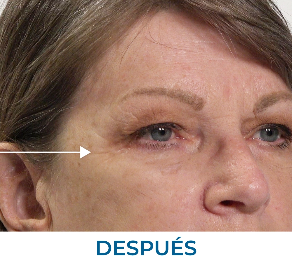 Mona after applying Rapid Reduction Serum