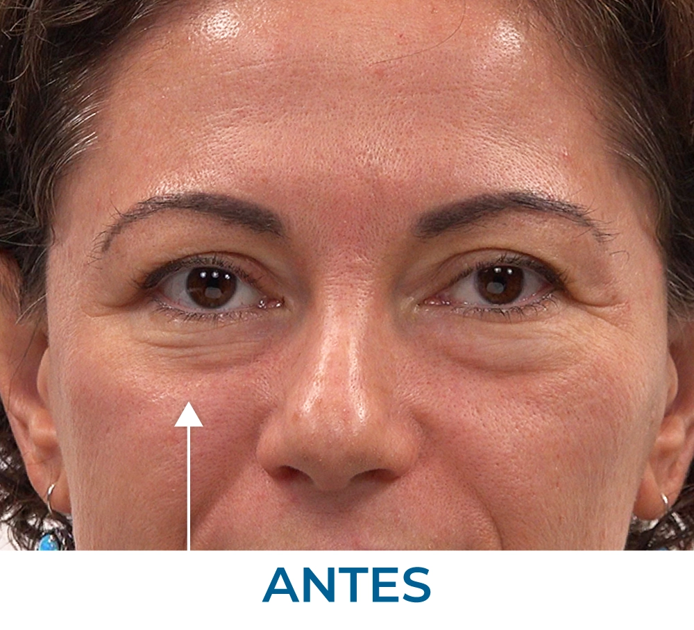 Rita Before applying Rapid Reduction Serum