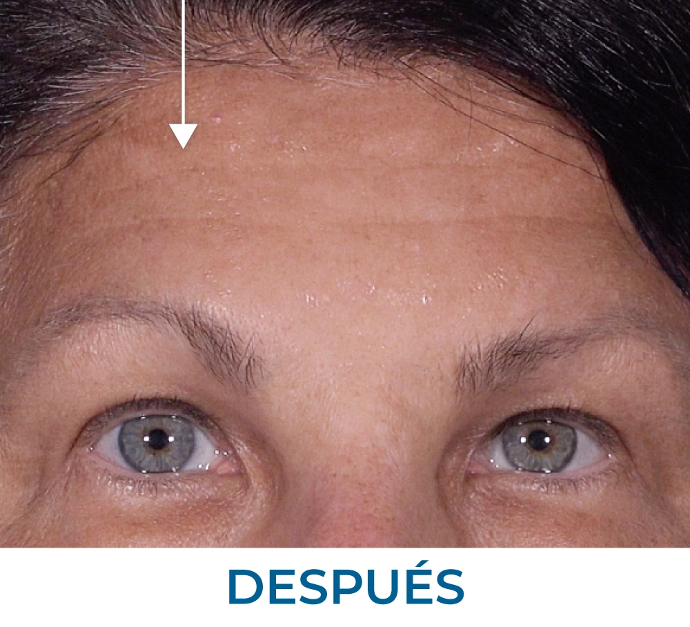 Tammy after applying Rapid Reduction Serum