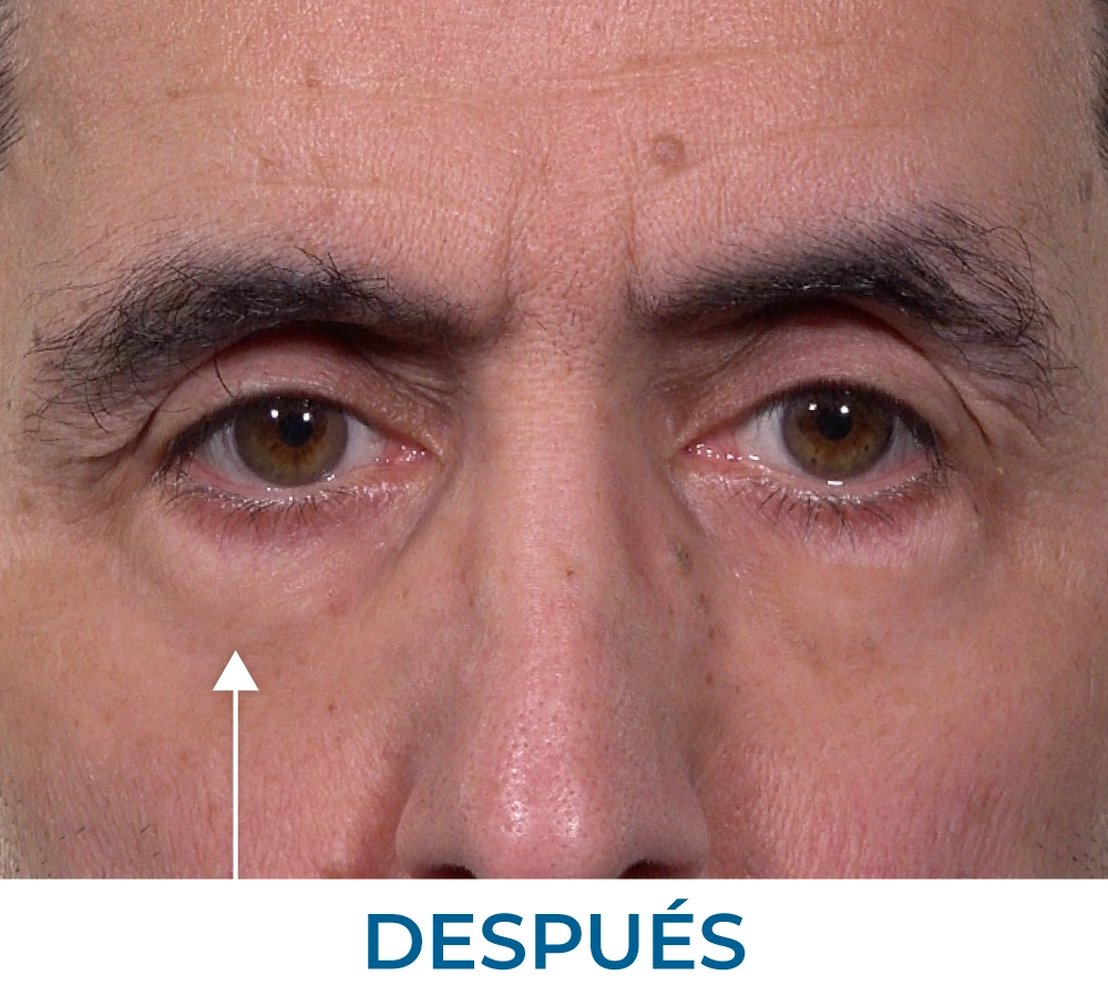 Ritchie after applying Rapid Reduction Serum