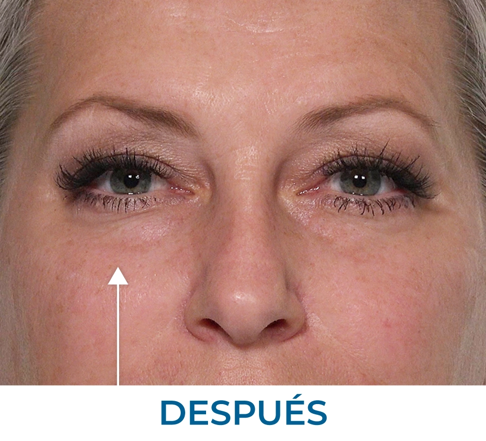 Tiffany after applying Rapid Reduction Serum