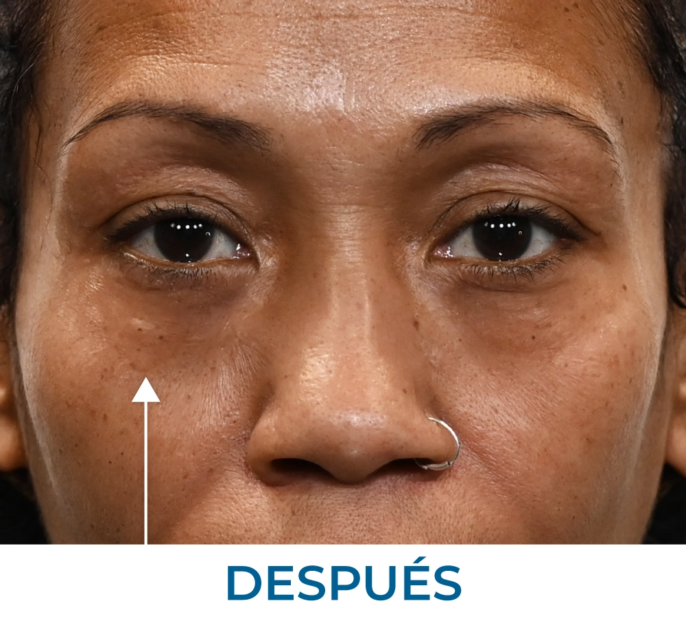 Sunny after applying Rapid Reduction Serum