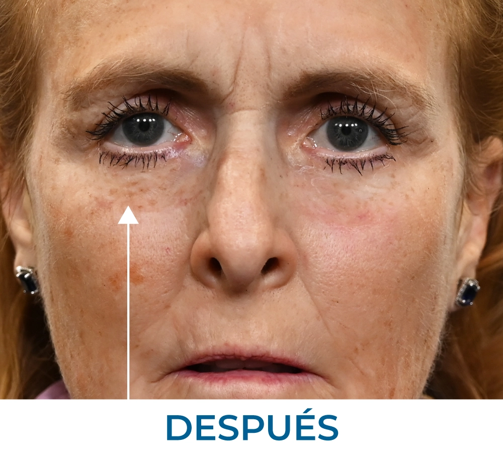 Marty after applying Rapid Reduction Serum