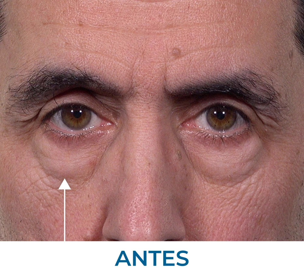 Ritchie before applying Rapid Reduction Serum