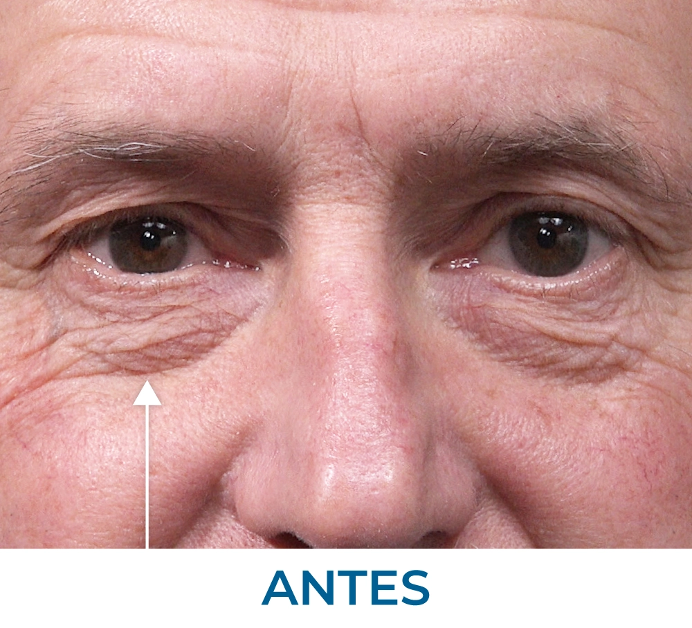 Ron before applying Rapid Reduction Serum