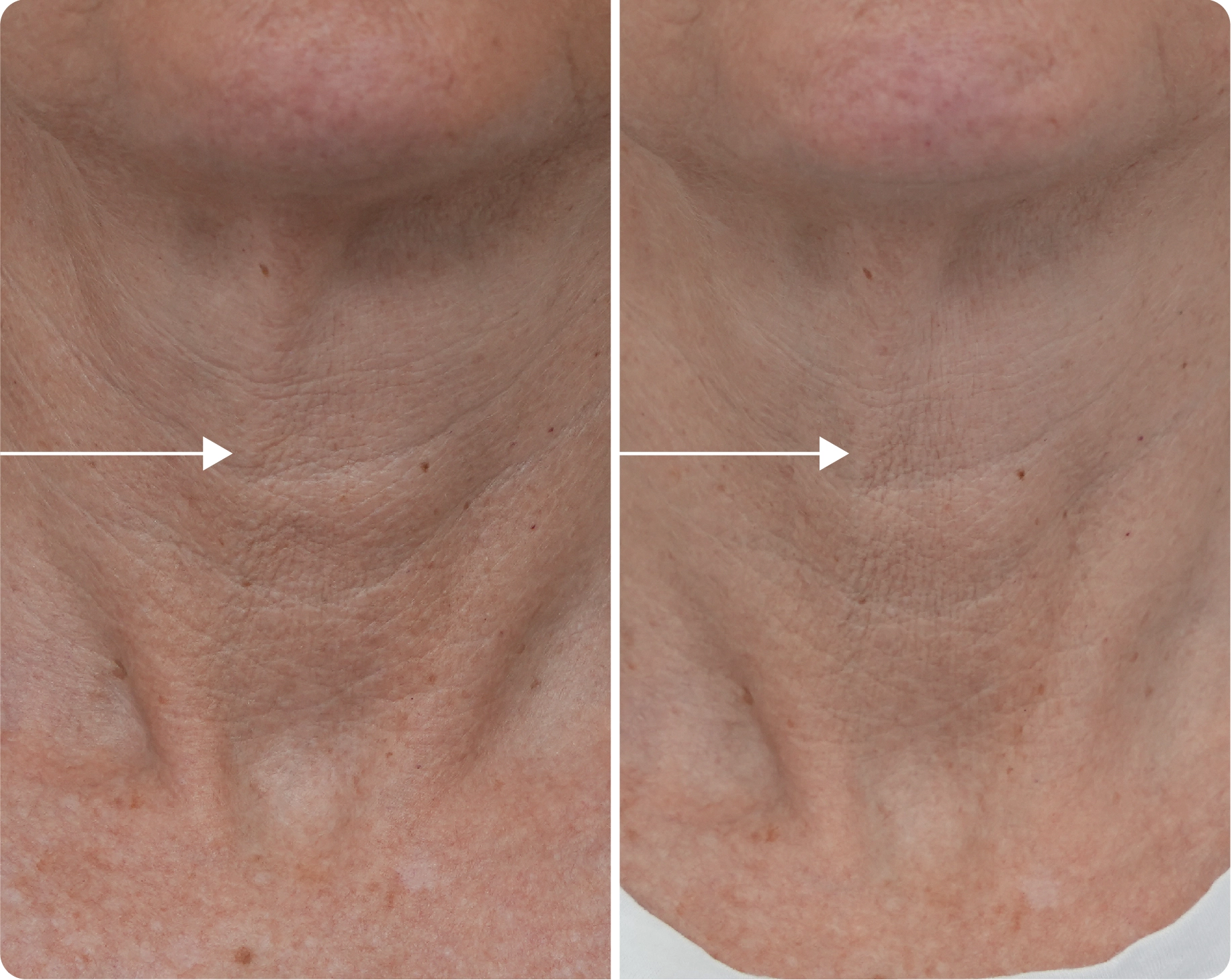 4 weeks after applying Neck Firming Cream