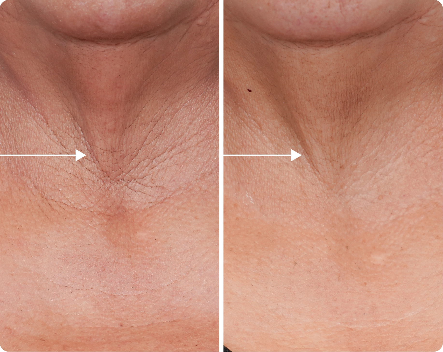 Dekliderm after 8 weeks