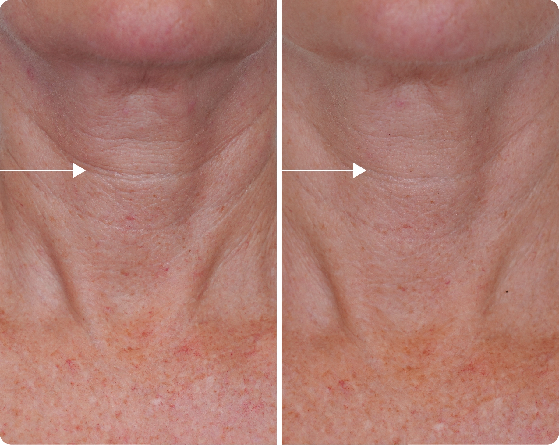 Dekliderm after 8 weeks