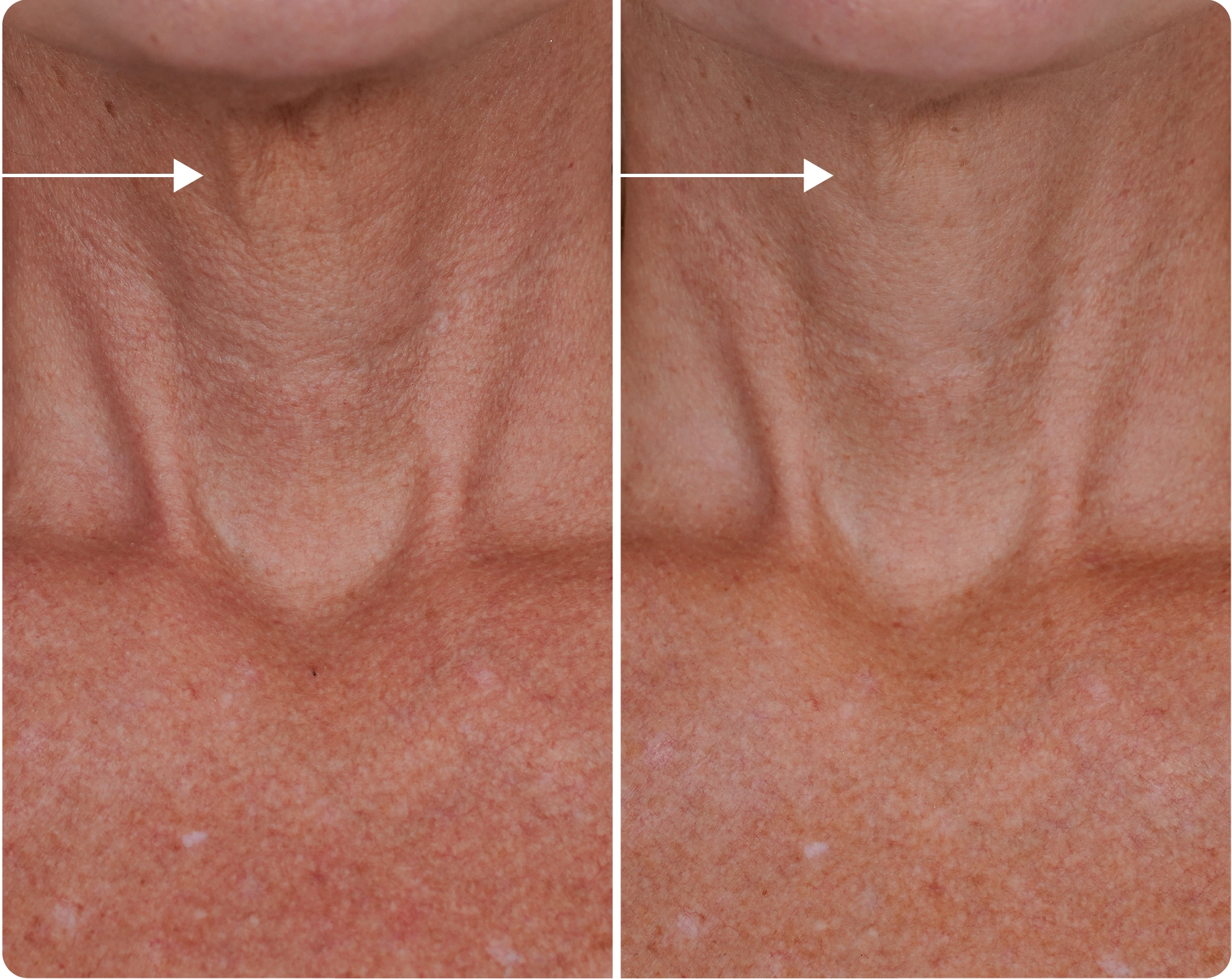 before and after applying Neck Firming Cream