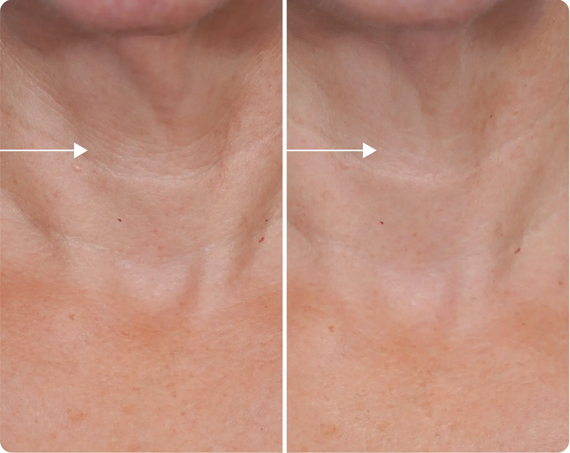 Dekliderm Cream after 4 weeks
