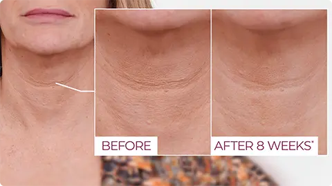 8 weeks after applying Neck Firming Cream