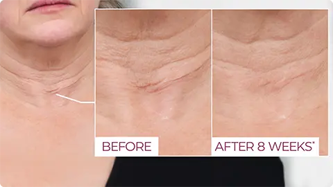 Dekliderm after 8 weeks