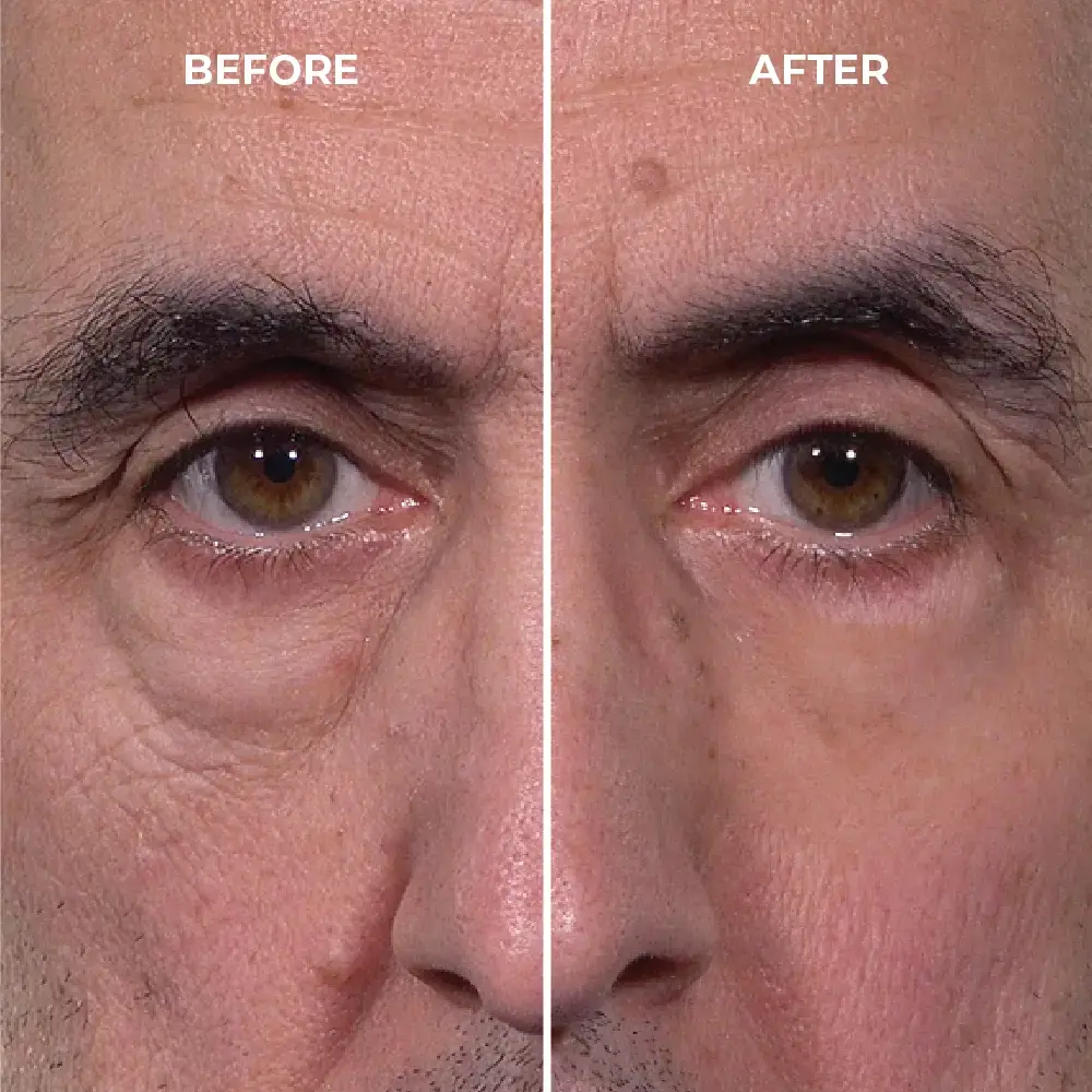 under eye bags and wrinkles