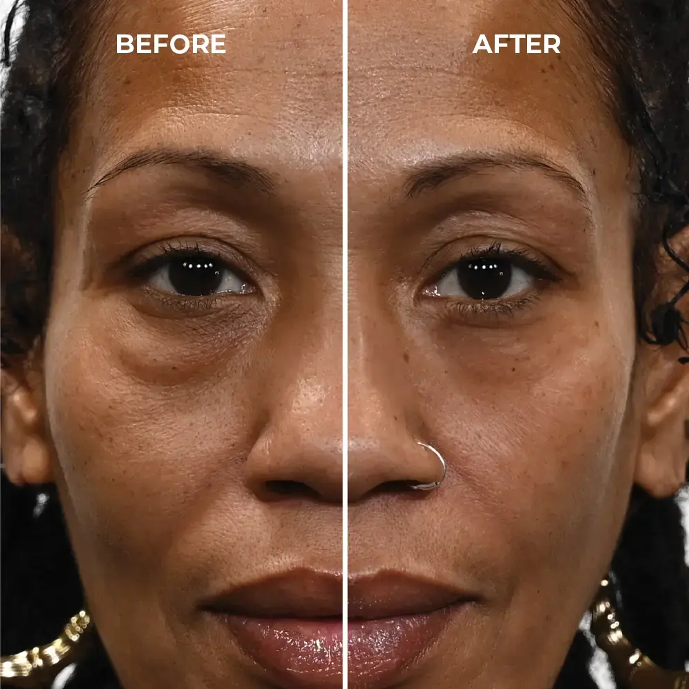 under eye bags and wrinkles