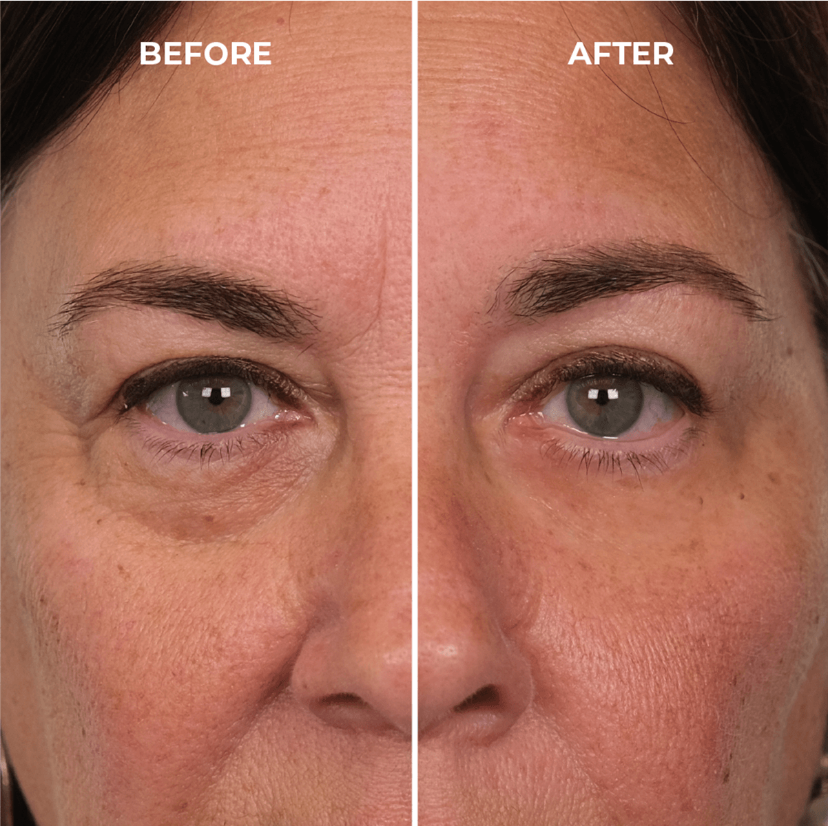 Before and after Plexaderm