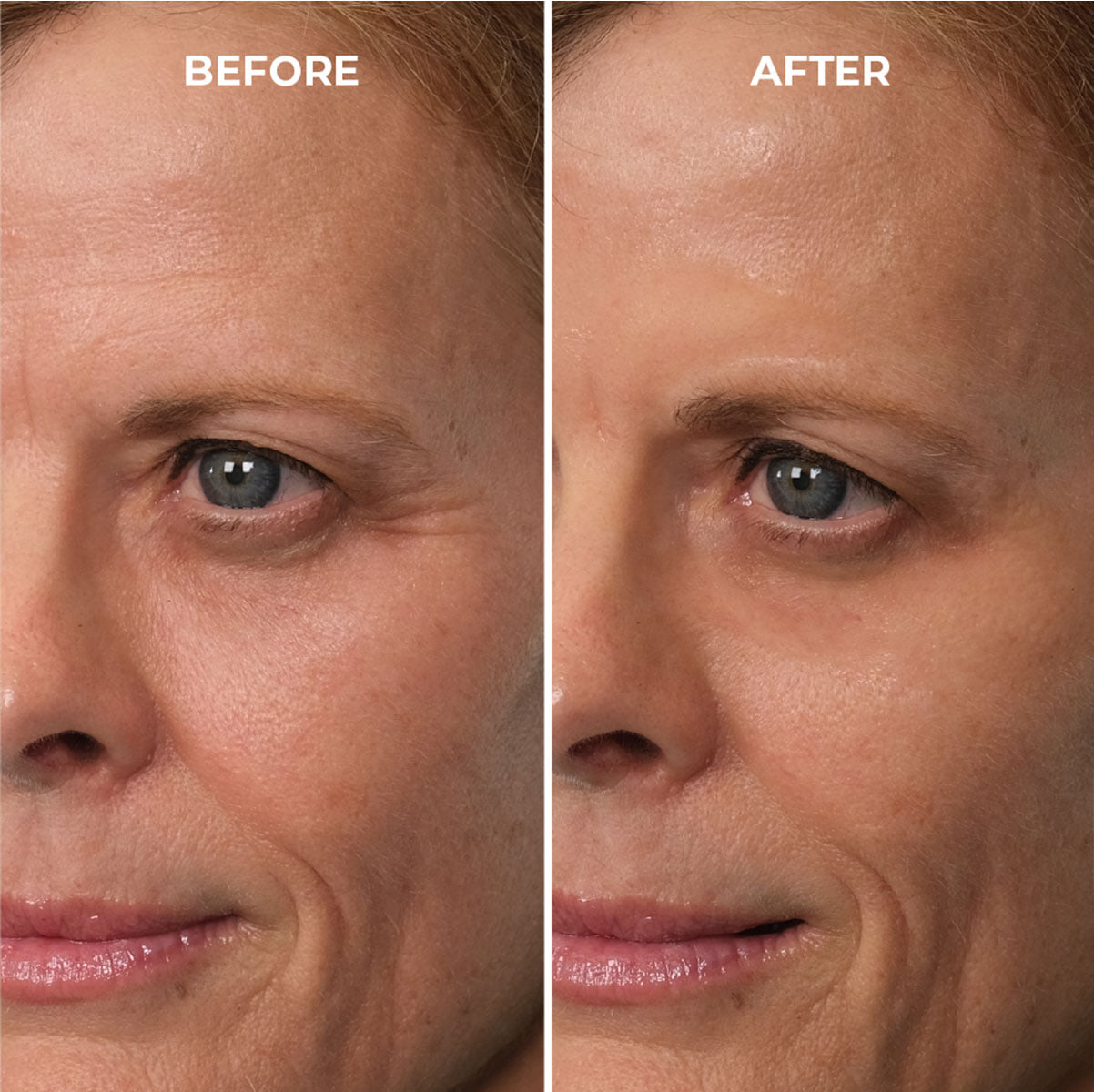 reduction in the look of wrinkles & crow's feet