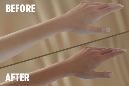 before and after on arm