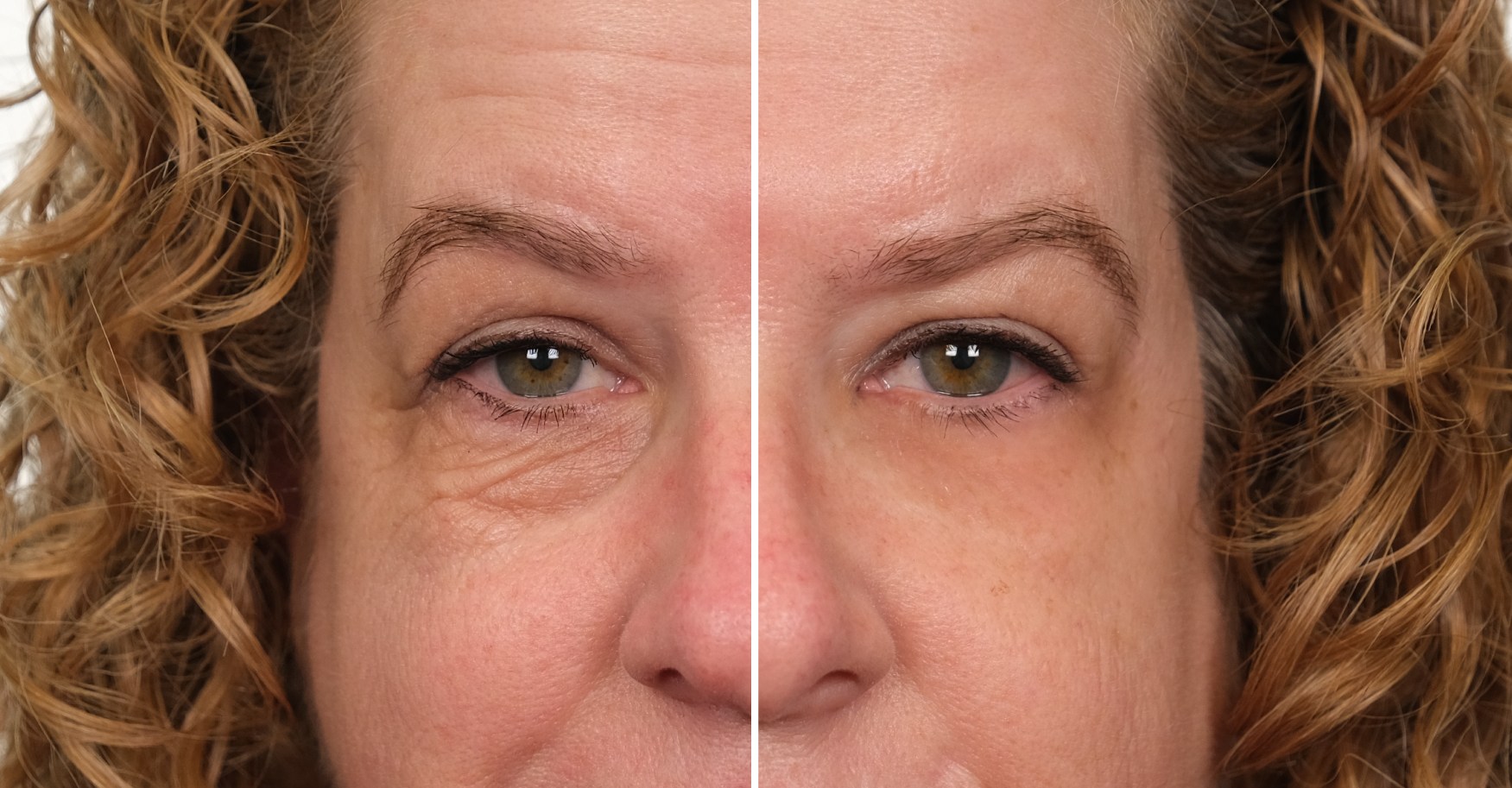 Plexaderm Trial Pack