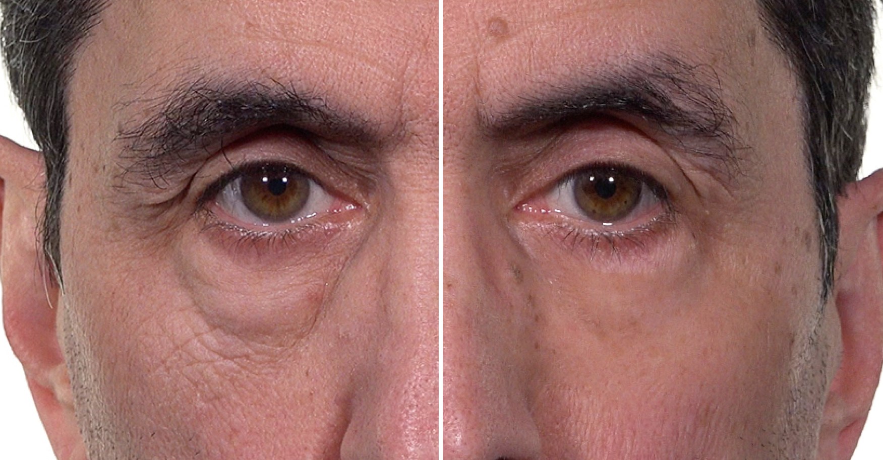 Plexaderm Trial Pack