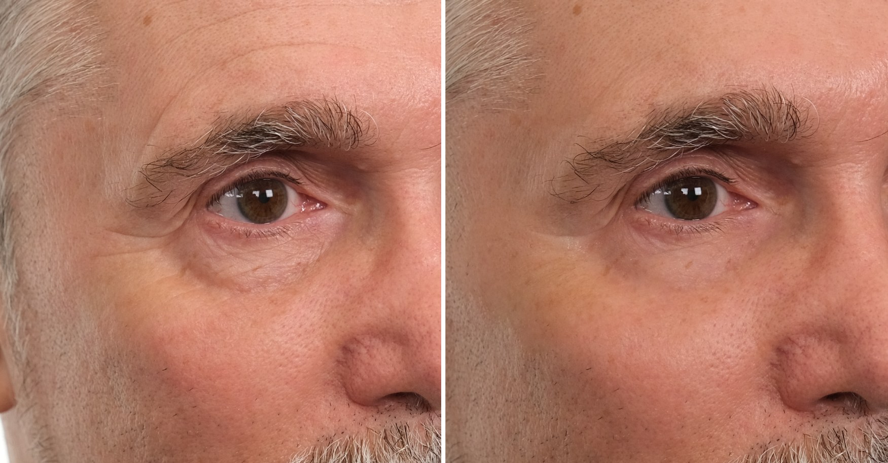 Puffiness under eyes, crow’s feet, forehead lines