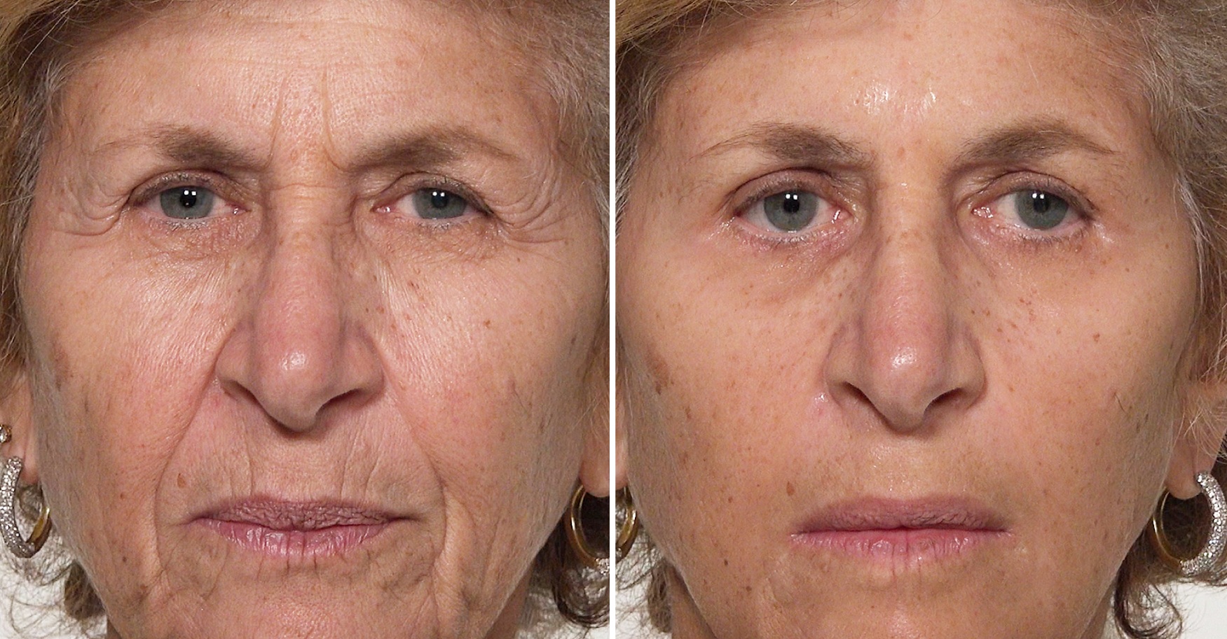 Plexaderm Trial Pack