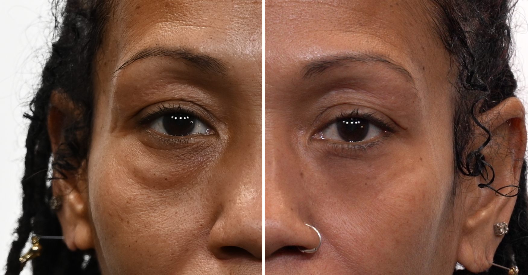 Plexaderm Trial Pack