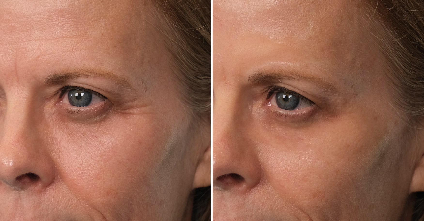 Crow’s feet, forehead lines